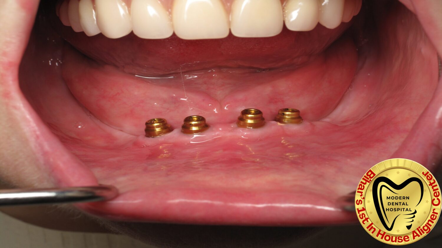 All-on-4 dental implants placed in lower jaw in Patna