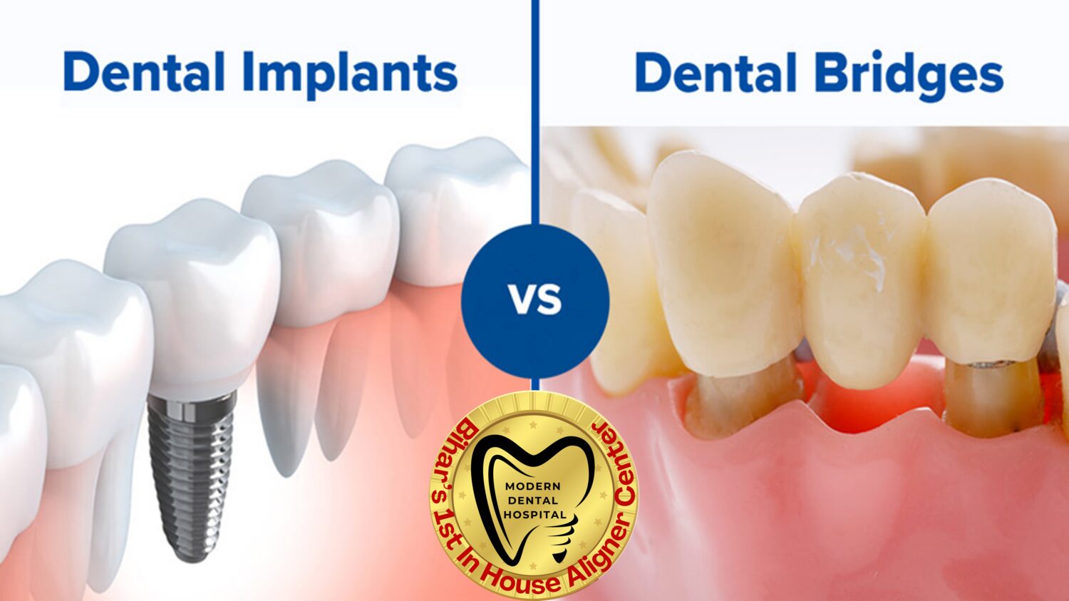 Dental implants vs dental bridges comparison Patna