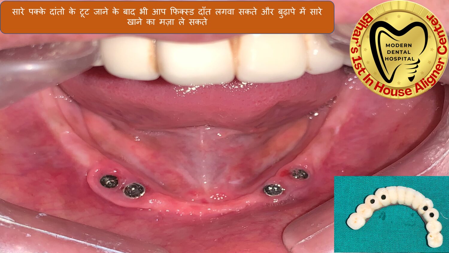 Full arch fixed teeth on implants Patna
