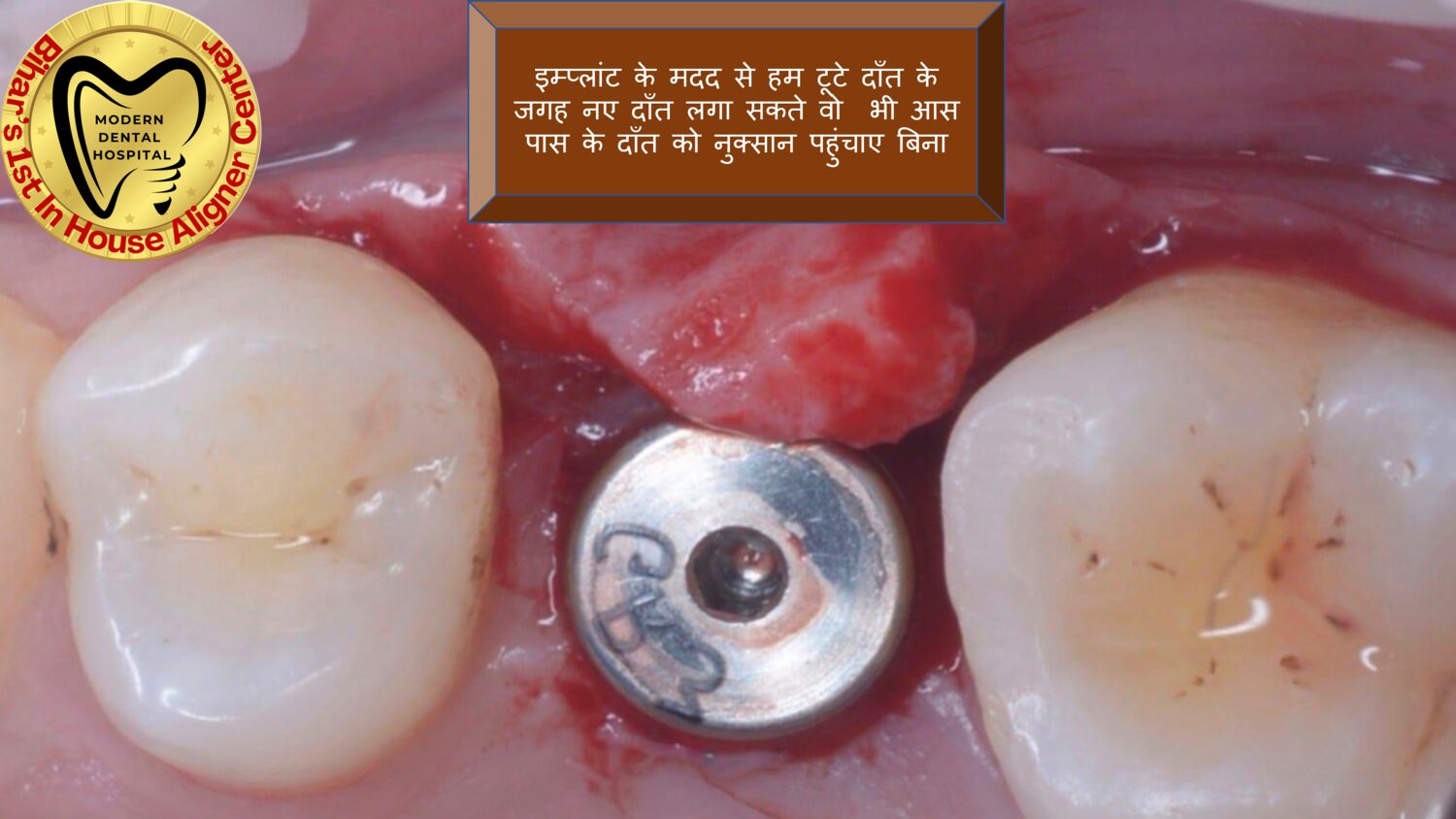 Single tooth implant placement in Patna without harming adjacent teeth