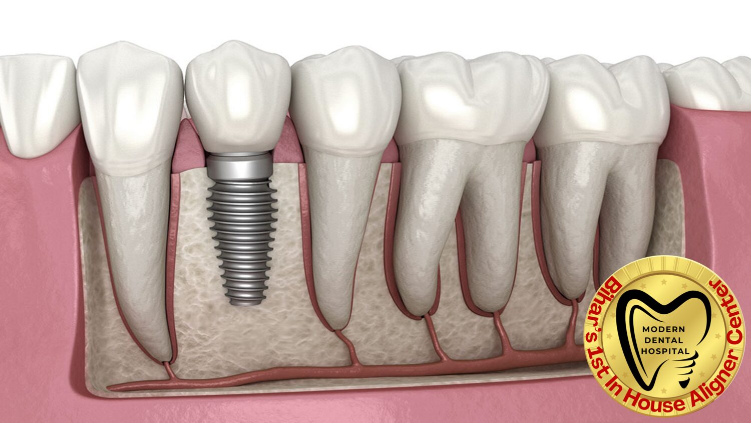 Single tooth dental implant in Patna between two molars